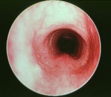 Intraoperative endoscopic view of a normal subglot