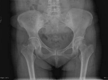 Bilateral central fracture-dislocation of hips after myelography