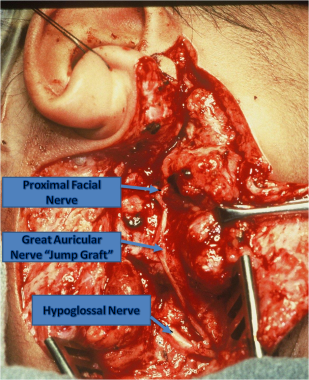 Congenital Facial Paralysis Treatment & Management: Medical Therapy,  Surgical Therapy, Preoperative Details