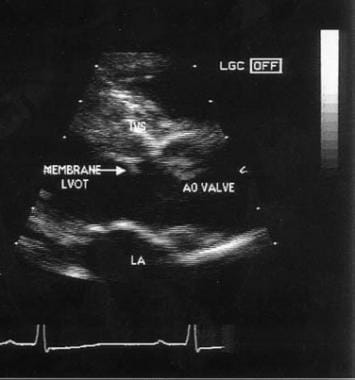 Echocardiogram of membranous subaortic stenosis. A