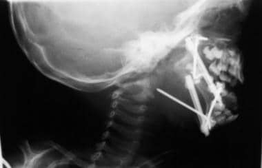 Right-lateral cranial radiograph of an 18-month-ol