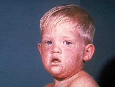 Face of boy with measles. 