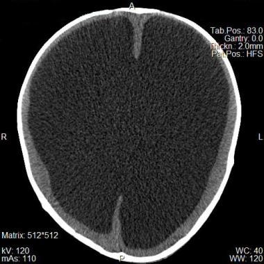 Noncontrast CT scan of brain of a 2-year-old boy s