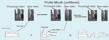Mouth analysis using video-to-scalar method. Mouth