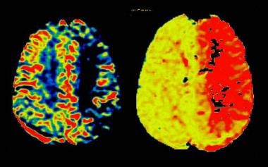 Magnetic resonance imaging in acute stroke. Left: 