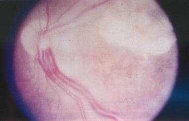 von Hippel-Lindau disease. Clinical picture of the