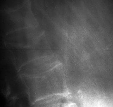 Osteoporotic spine. Note the considerable reductio