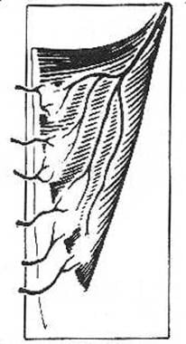 Type V, vascular patterns of the muscle and muscul