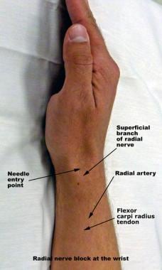 Radial nerve block at the wrist. 