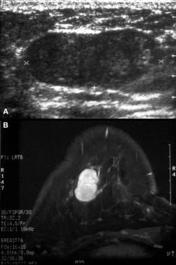 A, Sonogram shows a large fibroadenoma (proven at 