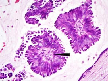 Pathology of small, peripheral intraductal papillo