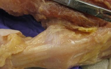 The sagittal bands of the thumb metacarpophalangea