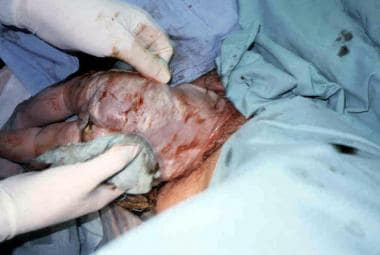 Assisted vaginal breech delivery. With a towel wra
