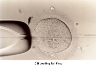 Infertility. Intracytoplasmic sperm injection load