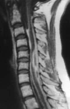 T1-weighted sagittal MRI of the cervical spine in 