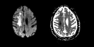 MRI was obtained to further clarify the findings o