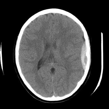 The epidural hematoma shown above extends superior