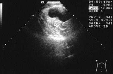 Axial sonogram through the right iliac fossa in a 