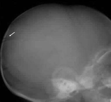 Occipital skull fracture due to a nonaccidental in