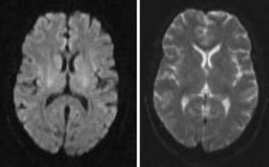 Normal brain appearance in axial DWI (left) and AD