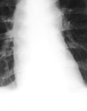 Frontal chest radiograph demonstrates calcificatio