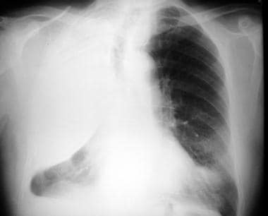 Posteroanterior (PA) chest radiograph in a 52-year
