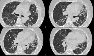 High-resolution CT (HRCT) shows increased pulmonar