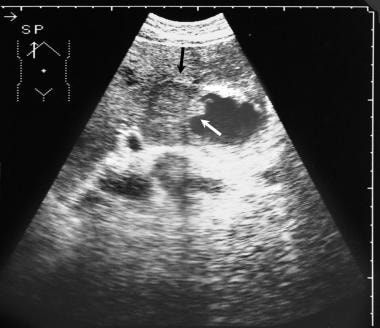 Ultrasonogram of the gallbladder shows focal thick