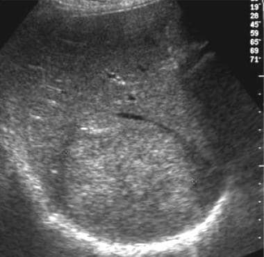 Ultrasound scan through the right lobe of the live