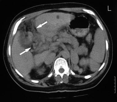 Contrast-enhanced axial CT (same patient as in the