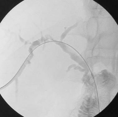 Multiple ischemic biliary strictures documented du