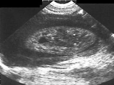 Sonogram in a 62-year-old man who presented with p