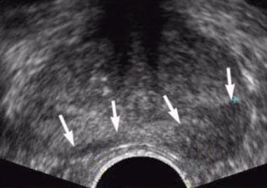 Axial transrectal ultrasonographic scan shows a hy