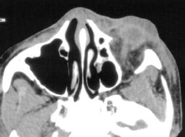 Axial computed tomography scan of orbital and faci