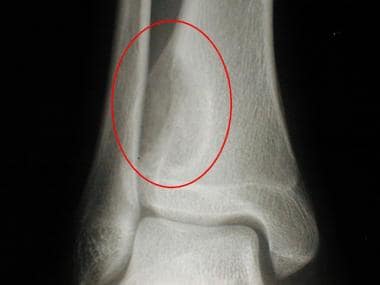 Radiograph of the distal tibia of a 16-year-old bo
