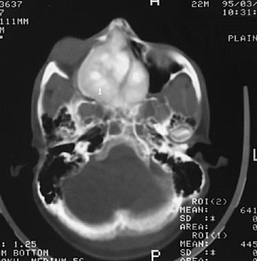 Image shows focal areas of calcification in cranio