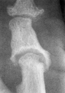 Anteroposterior radiograph of the thumb shows arth