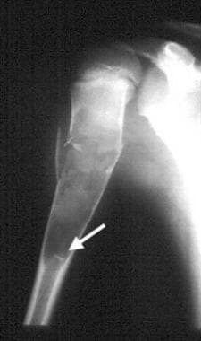 An 11-year-old boy with a simple bone cyst in the 