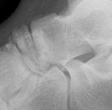 Lateral radiograph of a talonavicular fracture dis