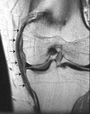 medial collateral ligament mri