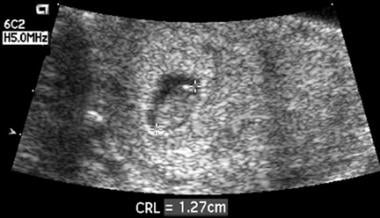 4 week vaginal ultrasound pictures