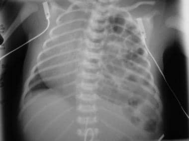 Anteroposterior (AP) view of the chest in a patien