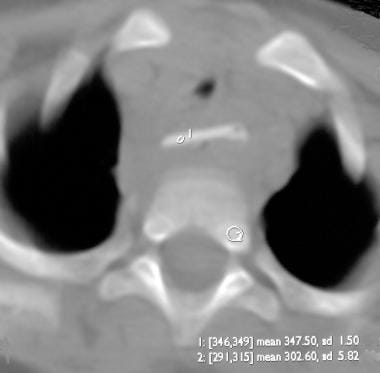 Nonenhanced axial CT scan demonstrates a retained 