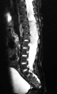 Sagittal T2-weighted MRI in the same patient as in