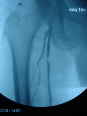 A 52-year-old male with right lower extremity inte