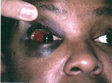 Lateral subconjunctival hemorrhage. 