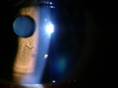 Corneal foreign body. 