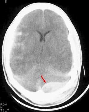 Subdural hematoma - Emergency neuroradiology. Axia