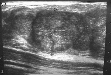 Fibroadenoma. Ultrasonogram courtesy of Helen Pass