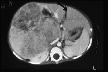 CT scan of a hepatoblastoma amenable to surgical r